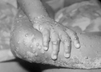 Viruela del mono: Minsa declarará la alerta, pero aún no se detectan casos en Perú