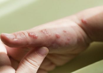 Viruela del mono: Minsa denuncia que personas monitoreadas no detallan con quiénes mantuvieron contacto