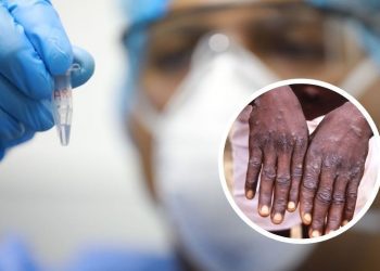 Viruela del mono: número de infectados se eleva a 282 y enfermedad se mantiene en nueve regiones del país