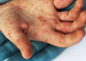 Viruela del mono en Perú: ¿dice el Minsa sobre el primer caso en un niño?