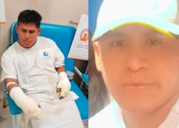 Lima: sujeto agrede a su expareja y le deja el 90% del cuerpo quemado