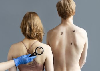 Muertes por melanoma aumentaron en 22% en dos años en Perú