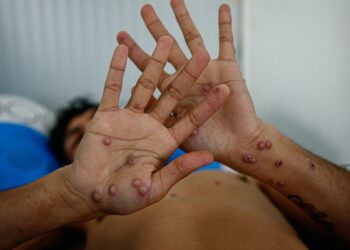 Viruela del mono: epidemiólogo de la UCV ofrece claves de protección en medio de la alerta global